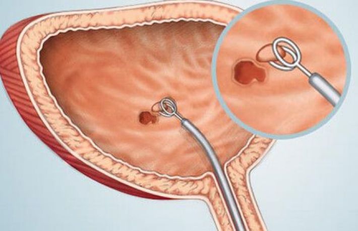 tratament cancer vezica urinara supozitoare cu meloxicam pentru prostatită