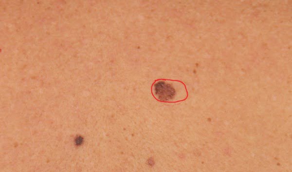 cancerul de piele