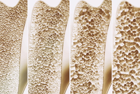 sfatul medicului osteoporoza