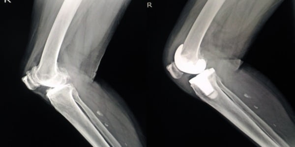sfatul medicului protezarea articulara