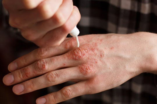 psoriazis diagnostic