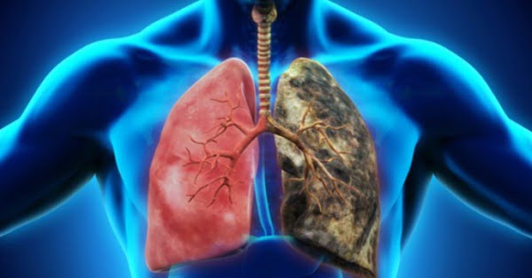 cancer pulmonar