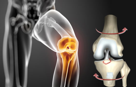 leziunea de ligamente încrucișat