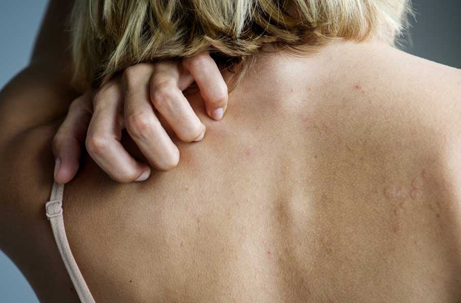 eczema