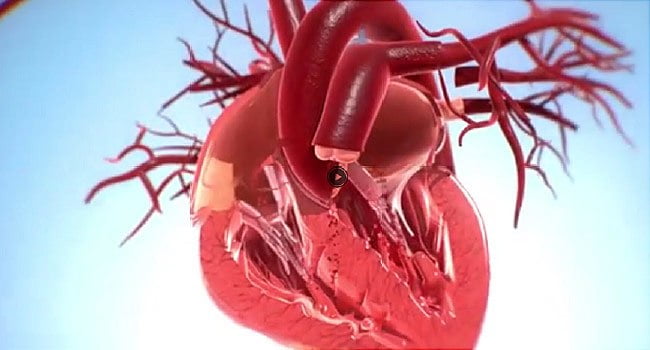 valve aortice viabile