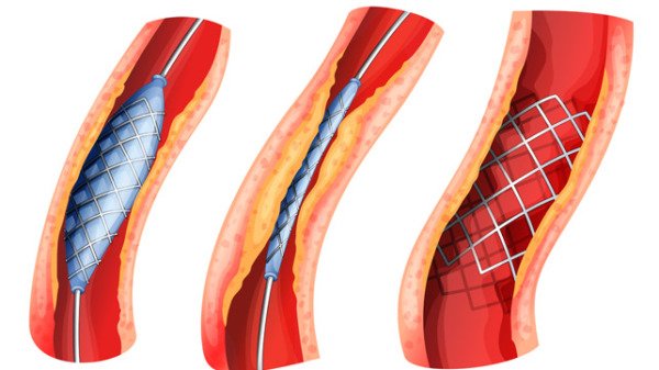 arteriopatia