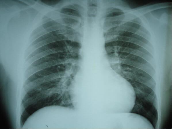 Hipertensiunea Arterială Pulmonară