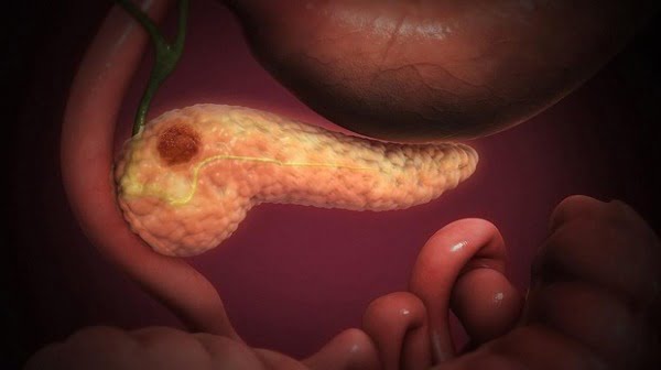 cancerul de pancreas