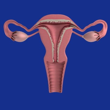 chistul ovarian