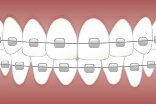 Tratamentul ortodontic