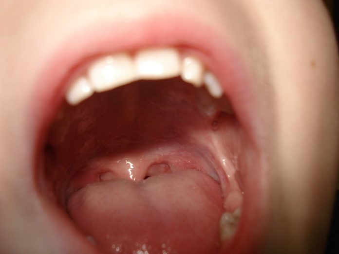 bolile limbii