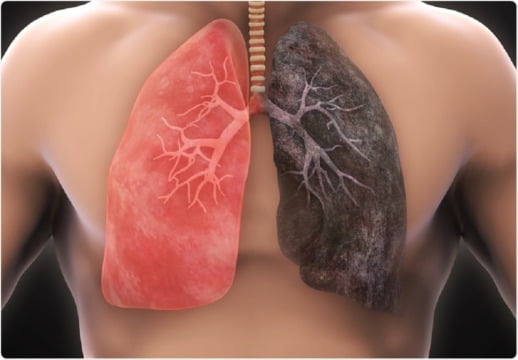 cancerul pulmonar
