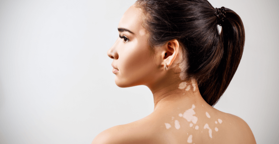 Vitiligo - Cum se manifestă, complicații, factori de risc, tratament