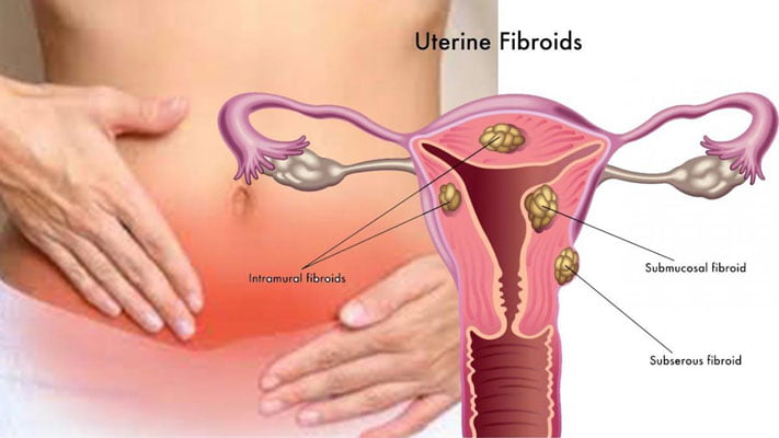 Ce sunt fibroamele uterine? - Cauze, Simptome, tratament