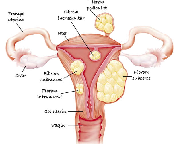 cum arata fibromul uterin