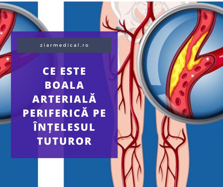 Ce este boala arterială periferică pe intelesul tuturor
