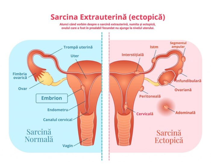 sarcina ectopica sarcina extrauterina grafic